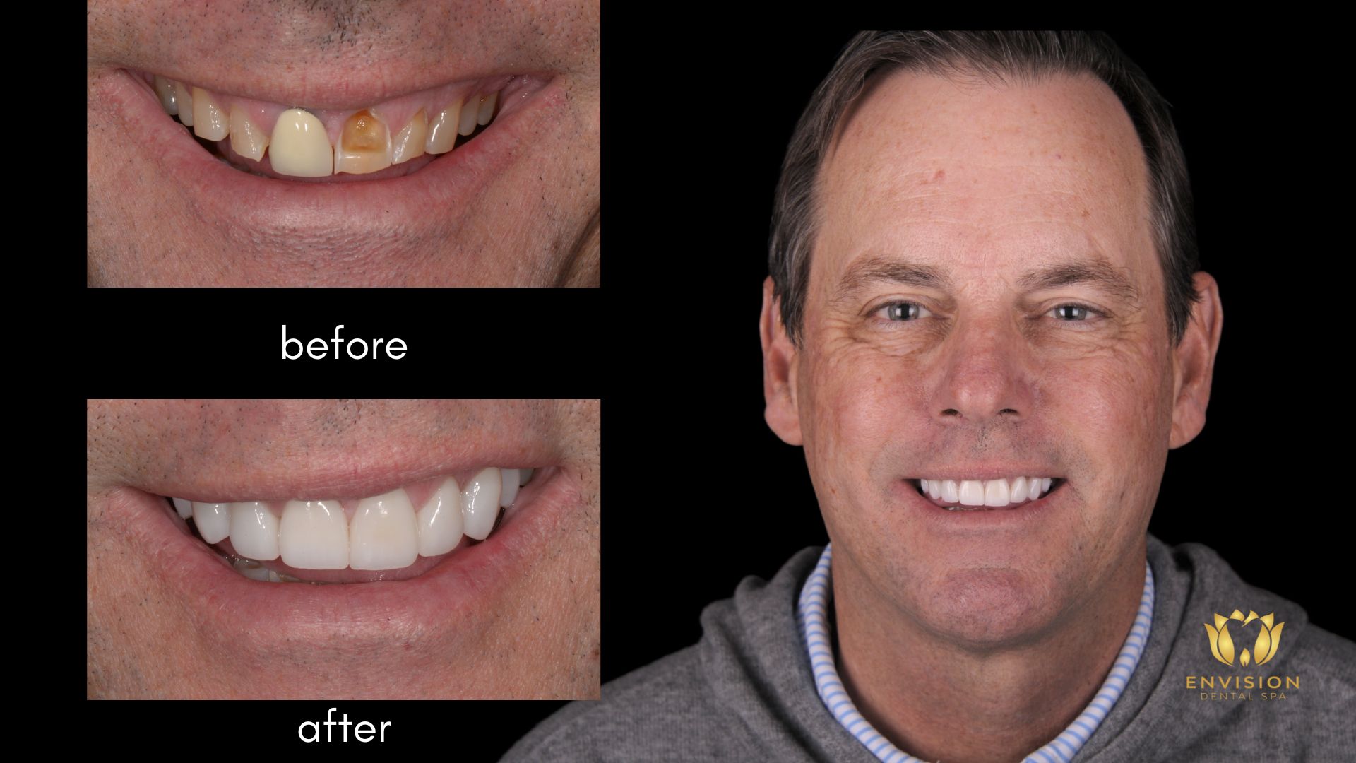 Trey - Complete Smile Makeover by Dr. Kabbani